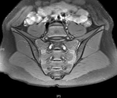 Effectiveness of tumor necrosis factor inhibitors in children with enthesitis-related arthritis: a single-center retrospective analysis